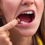 Perdida de dientes